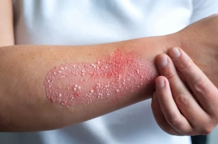 Eczema Treatment in Vadodara: Symptoms, Causes & Homeopathic Care